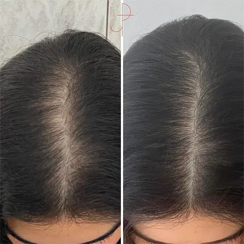Antes e depois de uma cliente da Consulta de Tricologia Integrativa